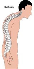 Thoracic curve is exaggerated (humpback)
Causes: osteoporosis, abnormal vertebral growth