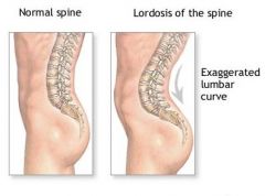 The Lumbar curve is exaggerated
May occur during pregnancy