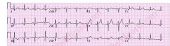 Pathological Q waves indicative of old MI, see in AVF 2 and 3 most likely inferior wall MI