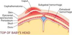 what are the anatomic locations of the different injuries to the head during birth