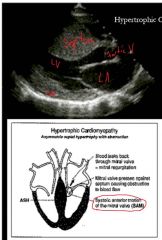 Seen with hypertrophic cardiomyopathy, mitral valve pushes against septum obstructing blood flow reducing preload.

Systolic murmur created, improves with leg raising (increased blood to heart, opening up the cavity and preventing the obstructio...