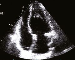 Associated hypertension, ventricular morphology distorted outflow tract, 

Sigmoid septum (pictured), with systolic anterior motion of mitral valve (grandma SAM)