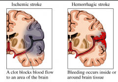 1.) Cerebrovascular Accident (Stroke): acute neurologic dysfunction of vascular origin, w/ symptom & signs corresponding to the focal area of the brain affected
2.) Ischemic (80%-result of embolism traveling to brian)) and Hemmorrhagic (20%- brain...