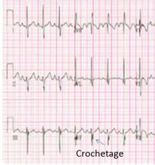 more common in females.  Small = asymptomatic.  !FIXED SPLIT S2!  Pulmonic systolic ejection murmur

Primum = lower, RBBB, AV block
secundum = mid (most common), incomplete RBBB, notched cortege IW QRS
sinus venosus = upper (to SVC)

repair ...