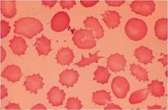 Burr cells/echinocytes/dessicocytes differential?  pointy ends