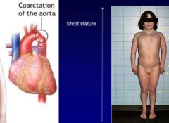 Coarctation of aorta, bicuspid aortic valve (50%), differential pulse (pre vs post coarctation vasculature), hypertension