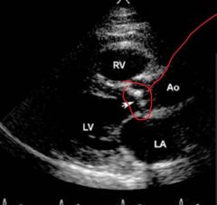 usually degenerative (fibrocalcific)

congenital bicuspid valve = faster degeneration

echocardiogram valve = too thick