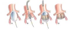 Trans catheter aortic valve replacement (TAVR)