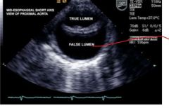 subintimal tear (separates media from intima), false lumen usually larger due to trapping blood

A = ascending, B = only descending

Risk: hypertension, pregnancy, coarctation, bicuspid aortic valve, Marfan's

Tearing pain along back, asymme...