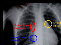Radiografia de torax: aumento de tamaño de auricula, ventriculo D, arteria pulmonar y trama vascular