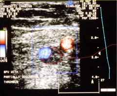 usually done with ultrasound, if mass is incompressible is likely a thrombus