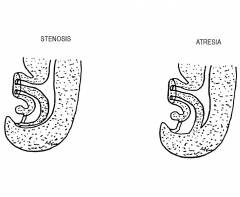 results from dorsal deviation in the path of the growth of the urorectal septum. 

If the
urorectal septum fuses with the posterior wall of the cloaca, rather than the cloacal
membrane, it will result in complete atresia.