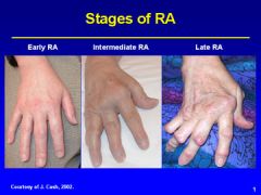 Rheumatoid arthritis (systemic inflammation, joint pannus, boutonnière deformity)