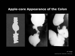 “Apple core” lesion on abdominal x-ray