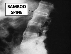 “Bamboo spine” on x-ray