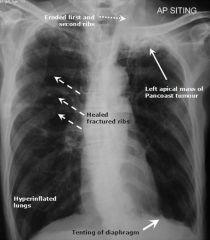 Bronchogenic apical lung tumor on imaging