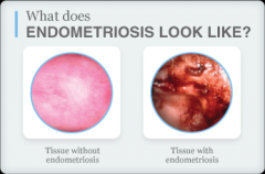 Endometriosis (frequently involves both ovaries)