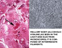 Mallory body (alcoholic liver disease)