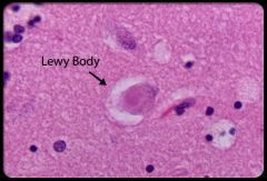 Lewy body (Parkinson disease)
