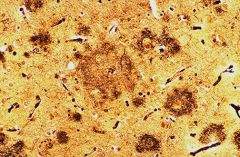 Senile plaques (Alzheimer disease)