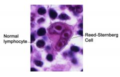 Reed-Sternberg cells (Hodgkin lymphoma)