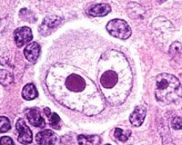 Giant B cells with bilobed nuclei with prominent inclusions (“owl’s eye”)