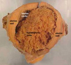 Choriocarcinoma, hydatidiform mole (occurs with and without embryo, and multiple pregnancy)