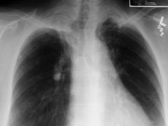 Hilar lymphadenopathy, peripheral granulomatous lesion in middle or lower lung lobes (can calcify)