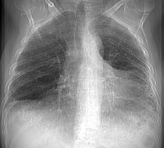 “Honeycomb lung” on x-ray or CT