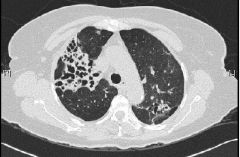 Interstitial pulmonary fibrosis