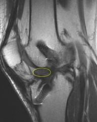 During  (ACL) recon divergence b/t the graft & screw fixation w/in the bone tunnel can lead to complications. Which statements re: graft-screw divergence is true? 1-Risk of failure is eliminated using an accessory anteromedial drilling portal; 2-C...