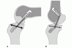 divergence greater than 15-30 degrees from the trajectory of the femoral tunnel may lead to failure of fixation and early ACL failure. Technical tips to avoid this complication include: inserting the screw and drill from the same portal (no diverg...