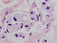 Denne særlige type celler findes i nogle ventrikkelkarcinomer - hvad kaldes disse?