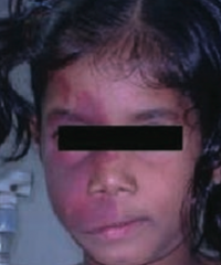 Port-wine stain on face 
- Caused by Sturge Weber Syndrome