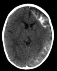 Ipsilateral leptomeningeal angioma → seizures / epilepsy
- Caused by Sturge Weber Syndrome