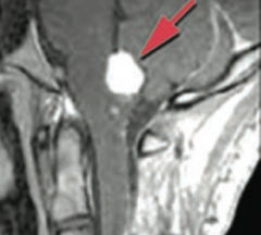 Hemangioblastoma in cerebellum
- Caused by von Hippel Lindau disease