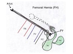 What distiguishes an inguinal hernia from a femoral hernia?
