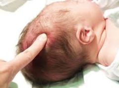 diffuse, edematous, and often dark swelling of the soft tissue of the scalp that extends across the midline and/or suture lines
this is found in children born vaginally in the occiput anterior position. There is pressure placed on the overriding p...