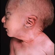 Decreased amniotic fluid volume1. IUGR, postmaturity, congenital anomalies of the fetal kidneys
2. bilateral renal agenesis results in Potter syndrome - clubbed feet, compressed facies, low-set ears, scaphoid abdomen, and diminished chest wall siz...
