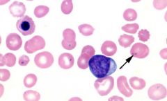Patient with aplenia or sideroblastic anemia