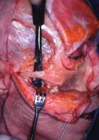 Glomus tumors in general are surgical diseases unless patient's comorbidities prevent operation. 

Requires proximal control of the great vessels in the neck and the sigmoid sinus. 
Large tumors = may require transposition of the facial nerve t...