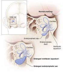 That of endolymphatic hydrops - likely due to obstruction of the normal flow and resorption patterns of endolymph
- SNHL
- Tinnitus
- Aural fullness
- Vertigo
- Late sx include facial paralysis, sx of brainstem compression, and lower cranial ...