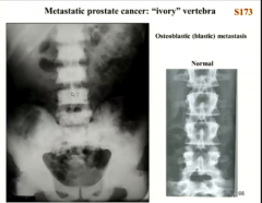 they appear more white like IVORY because this cancer encourages bone growth (osteoblastic metastasis)