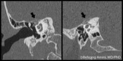 CT- infiltrative erosive lesion centered at the geniculate ganglion
- may erode into cochlea or labyrinth
- intratumor calcifications are common

MRI - on T1 imaging hypo to isointense to brain and enhance avidly with contrast