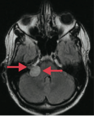 Schwannoma (if localized to CN VIII it is an acoustic schwannoma / acoustic neuroma)
- Schwann cell origin
