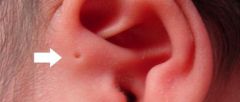 A child presents with a preauricular pit.  Now what?