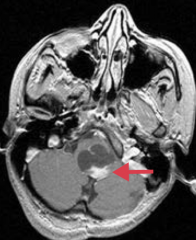 - Most often in posterior fossa (eg, cerebellum), but can be supratentorial
- Benign with good prognosis