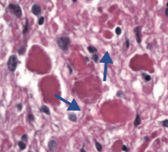 Pilocytic (low-grade) Astrocytoma