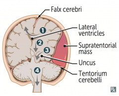 1. Cingulate (subfalcine) herniation under falx cerebri
2. Downward transtentorial (central) herniation
3. Uncal herniation
4. Cerebellar tonsillar herniation into foramen magnum