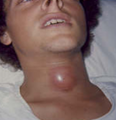Mass in midline
Moves with swallowing or tongue protrusion
May become infected